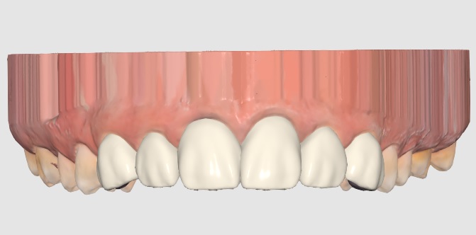 la imagen muestra un provisional de dientes digitales