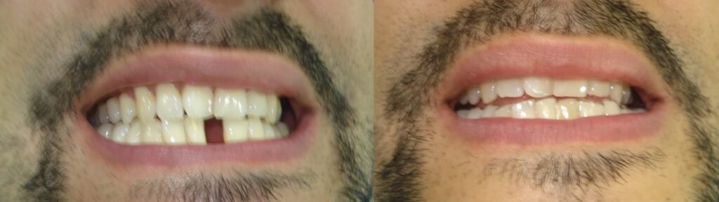 la imagen muestra antes y después de la dentadura temporal 