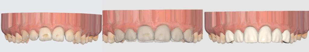 imagen muestra dientes falsos