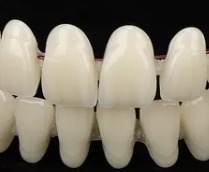 la imagen muestra un ejemplo de provisionales dentales 